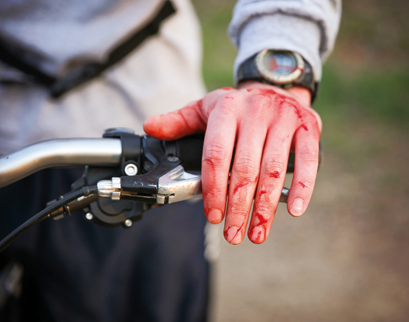 bike hand injury.jpg