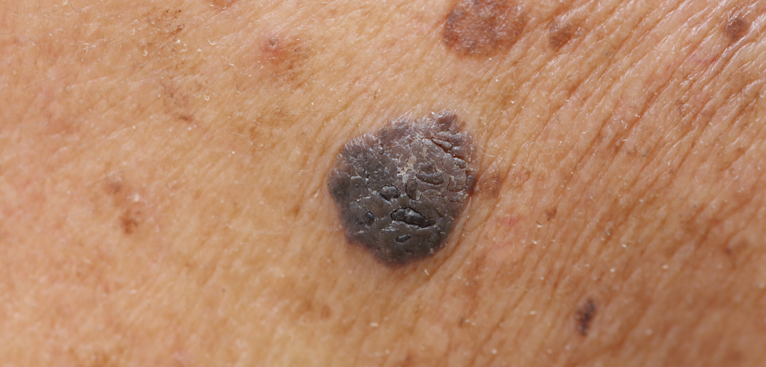 melanoma mole _1075x515.jpg