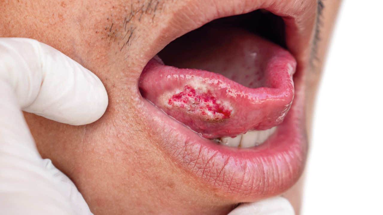 mouth, tongue, oral cancer.jpg